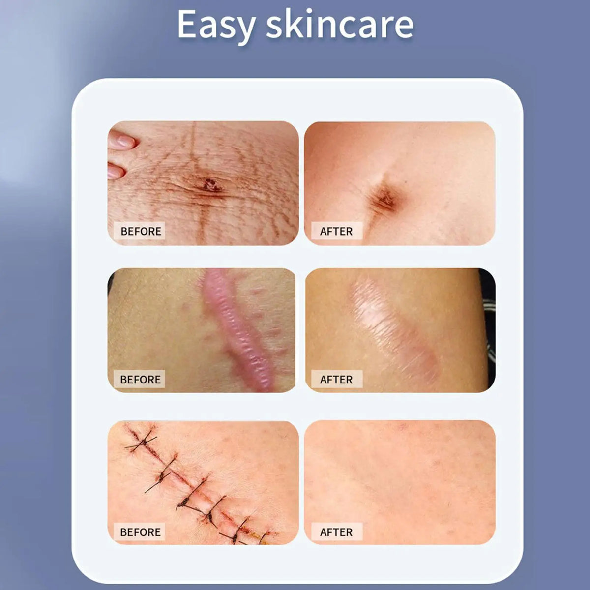 Waterproof Silicone Scar Sheets – Medical Grade Hypoallergenic Tape